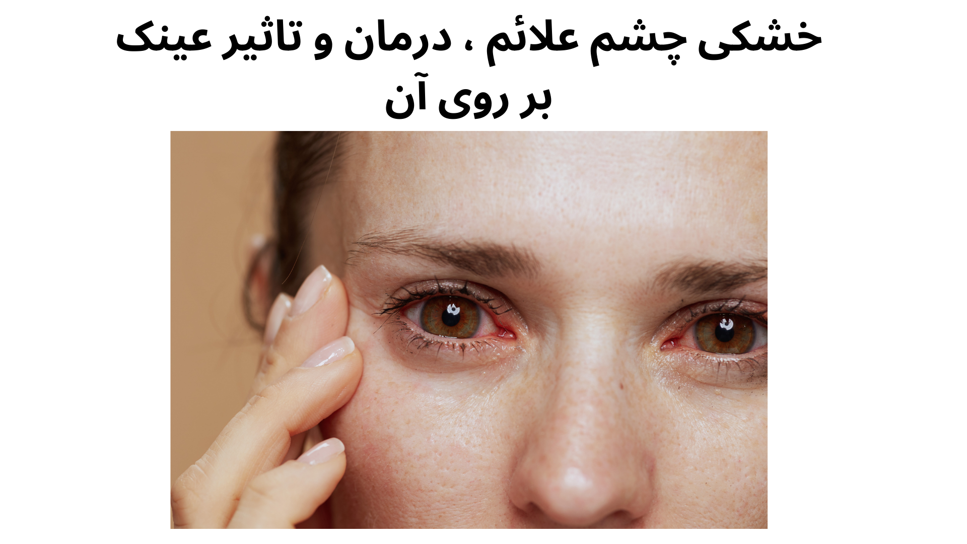 خشکی چشم، علائم درمان و تاثیر عینک بر روی آن
