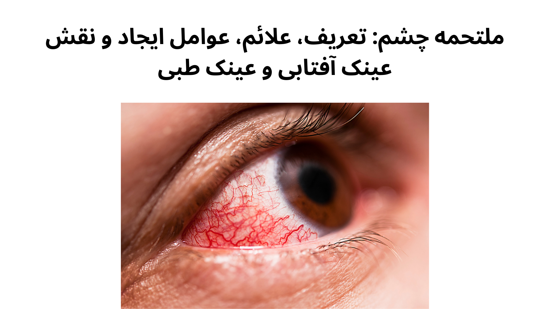 ملتحمه چشم: تعریف، علائم، عوامل ایجاد و نقش عینک آفتابی و عینک طبی